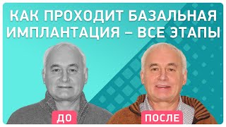 ?Подробное видео о том, как проводится базальная имплантация. Отзыв пациента клиники Smile-at-Once