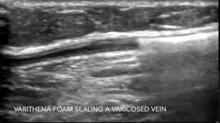 Ultrasound of Varithena Foam Sealing a Varicose Vein