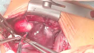 Blalock–Taussig Shunt