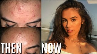 HOW TO REALLY GET RID OF ACNE IN ONE WEEK (WORKS!)