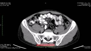 Metástase pericava e aorta