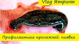 Профилактика пролежней с помощью пиявок, мой опыт