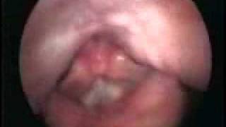 Stroboscopy: Flexible fiberoptic: female singing at a high pitch