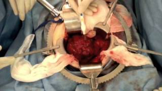 TeamCirisano Teaching Series: Ovarian Cancer Radical Surgery