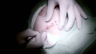 CHS Galen - operace, mamologie