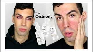 HOW I GOT RID OF MY REDNESS/ROSACEA - The Ordinary Arbutin + MORE