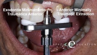Exodontia Minimamente Traumática Anterior - Anterior Minimally Traumatic Extraction