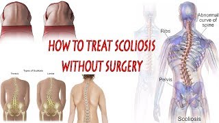 How to Treat Scoliosis | Scoliosis Exercises At Home | How to treat scoliosis without surgery