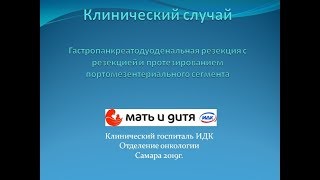 Гастропанкреатодуоденальная резекция с резекцией и протезированием портомезентериального сегмента