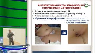 Сарычев С А - Наш опыт лечения расстройств мочеиспускания у детей с миелодисплазией