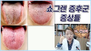 쇼그렌증후군 이 심해지면 혀에는 어떤 변화가 생길까요? 혀갈라짐 혀통증
