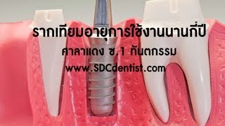 รากเทียม รากฟันเทียม อยู่ได้กี่ปี