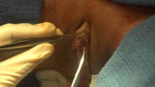 Labiaplasty Surgery San Francisco Plastic Surgeon Dr Rajagopal