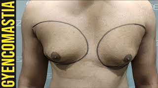 Remove Your Man Boobs ? | Watch This Gynecomastia Surgery Video In Hindi (Male Breast Reduction )