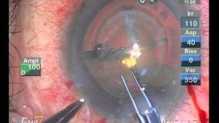 Femto second laser cataract surgery, bladeless at Eye7, Delhi, India