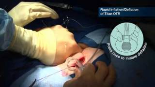 Coloplast Titan OTR Infrapubic Placement