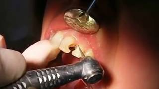 Diş dolgusu nasıl yapılır? Estetik diş dolgu yapımı. Çürük diş nasıl doldurulur? www.drsertac.com