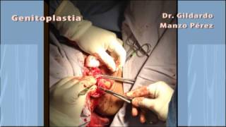 GENITOPLASTIA FEMINIZANTE