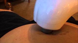 Two week checkup after umbilical hernia open mesh surgery