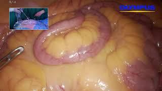 Lap D3 right colon resection 19.04.2019 Обнинск