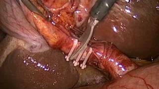 Laparoscopic Cholecystectomy
