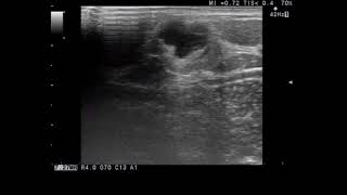 Объемное образование мягких тканей  грудной области на УЗИ