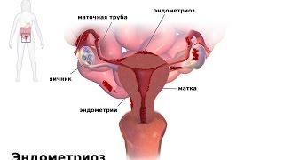 Эндометриоз матки лечение. Как лечить эндометриоз? Эндометриоз шейки матки. Молочница как лечить?
