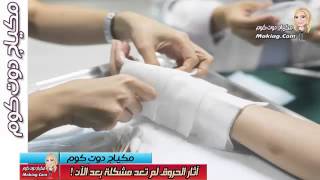 خلطات إزالة آثار الحروق | وصفة لازالة اثار الحروق نهائيا | توحيد لون البشرة | علاج اثار الحروق