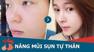 Cận cảnh nâng mũi SLine 4D sau 30 ngày | Sửa mũi bằng sụn tự thân