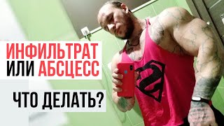 Абсцесс или инфильтрат на курсе ААС (Шишки после уколов)
