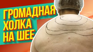 Липосакция ГИГАНТСКОГО горбика. Вдовий горбик