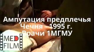 Ампутация предплечья. Чечня - 1995. Врачи ММА © Amputation of the forearm
