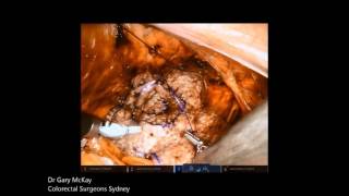 Robotic Ventral Rectopexy (RVR) for Rectal Prolapse and Obstructive Defecation - English
