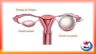 Remedios caseros para los quistes ovaricos - Tratamientos naturales para los quistes de ovarios