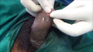 Paraphimosis - Corrective measure