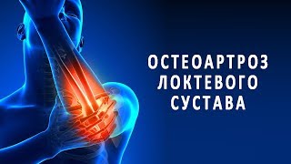 Остеоартроз локтевого сустава и его лечение