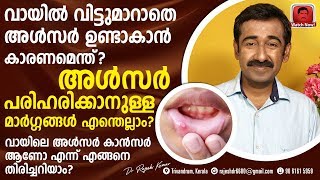 വായിൽ വിട്ടുമാറാതെ അൾസർ ഉണ്ടാകാൻ കാരണമെന്ത് ? അൾസർ എങ്ങനെ എളുപ്പത്തിൽ പരിഹരിക്കാം ?