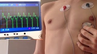Boy's ECG, fast heartbeat!