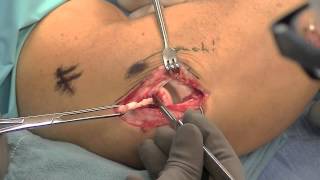 Lateral Epicondylar Release by Dr. Thomas Trumble