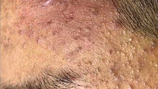 Best Blackheads Remover (Part 01)