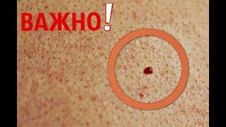 Что Означают Красные Родинки на Коже! Это должен Знать Каждый!