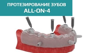 Протезирование зубов All-ON-4. Этапы имплантации и установки протеза на 4 имплантах