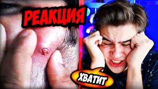 Мерзость! ВЫДАВЛИВАЕТ ПРЫЩИ АКНЕ НА ЛИЦЕ !! Выдавливают прыщи на лице !! Blackhead extraction on ear