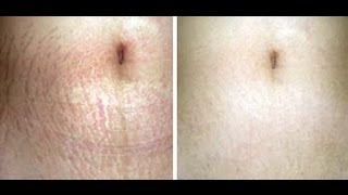GET RID OF STRETCH MARKS- How to get rid of stretch marks FAST!
