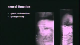 Neuromuscular Scoliosis and Neural Element Lesions