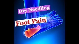 Dry Needling for PLANTAR FASCIITIS and Medial Foot Pain
