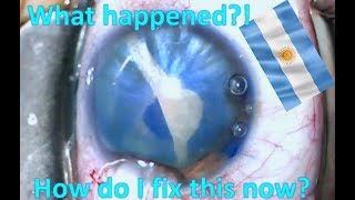 White Cataract: Run-Away Capsulorhexis -- how to fix it during cataract surgery