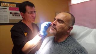 Watch Bellafill Acne Scars Treatment