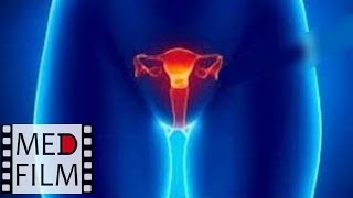 Опущение и выпадение матки и влагалища © Prolapse of the uterus and vagina