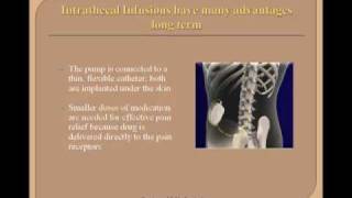 Chronic Pain Relief: Intraspinal Pump Therapy